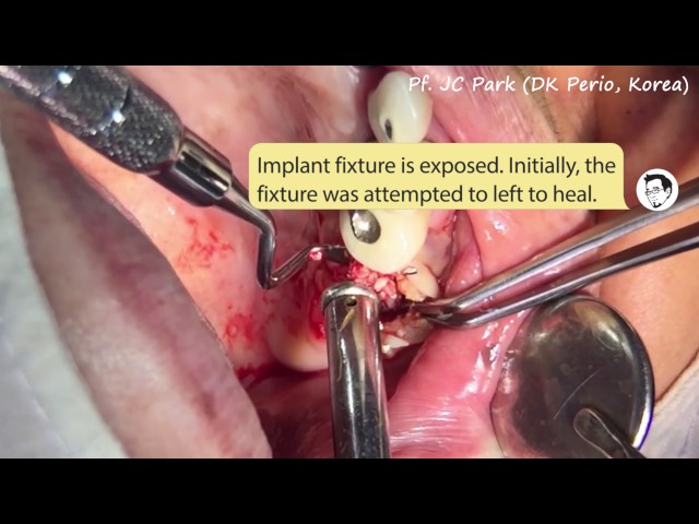 JCPARKLAND 박정철 교수 LECRURE 1 - Infection after sinus lift surgery d/t fungal infection