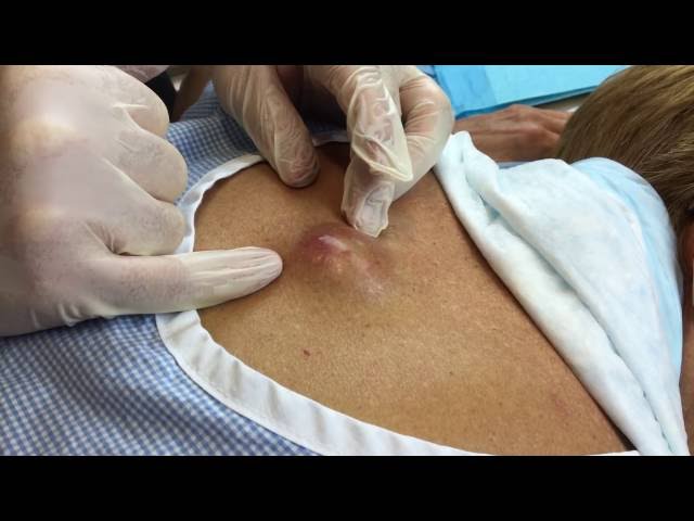 Infected Cyst on Mid-back