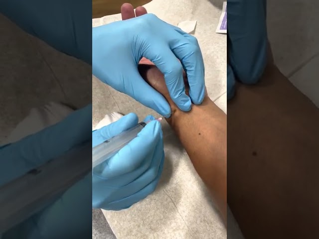 Ganglion Cyst Drainage at Plum Health DPC in Detroit