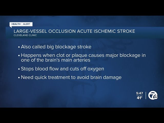 Strokes happening more in younger people, Cleveland Clinic research explains why