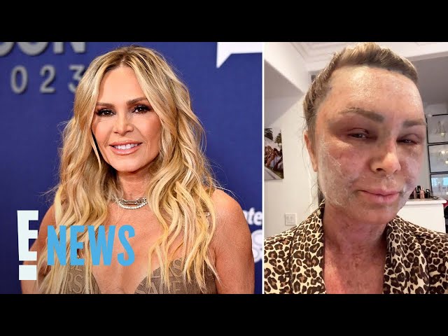 ‘Real Housewives’ Tamra Judge Looks Unrecognizable Following Cosmetic Surgery | E! News