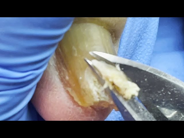 Ingrown nail treatment ,get rid of ingrown nail with effective method【Pedicure Master Lin Jun】