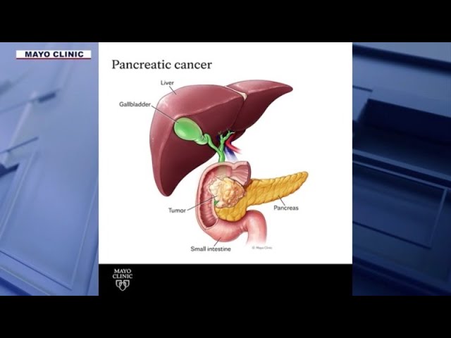 New hope in fight against pancreatic cancer l FOX 10 Talks