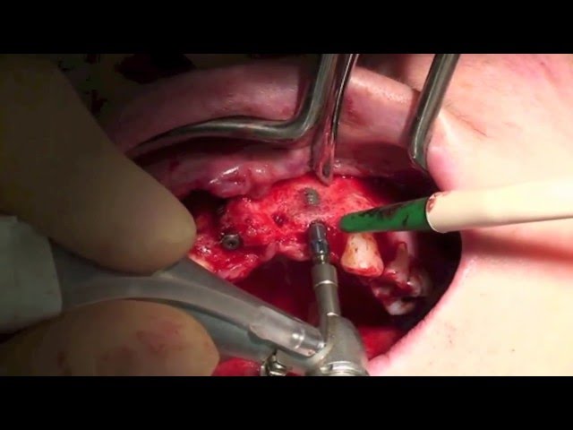 ITI Education week 2011 - Liver surgery, Eastman Dental Institute, London