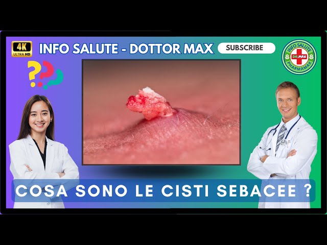 ⭐ SEBACEOUS CYST: Causes, Symptoms and Treatments    Health Info 👔 Dr. MAX