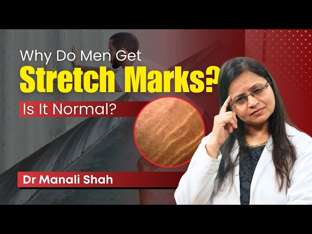 Why do men get stretch marks? | Clear Skin Pune - Dr. Manali Shah