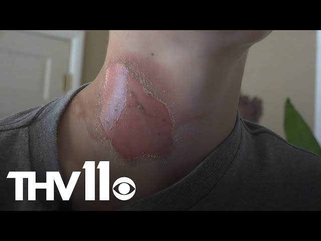 Sleeping teen suffers severe burns after friends throw boiling water on him