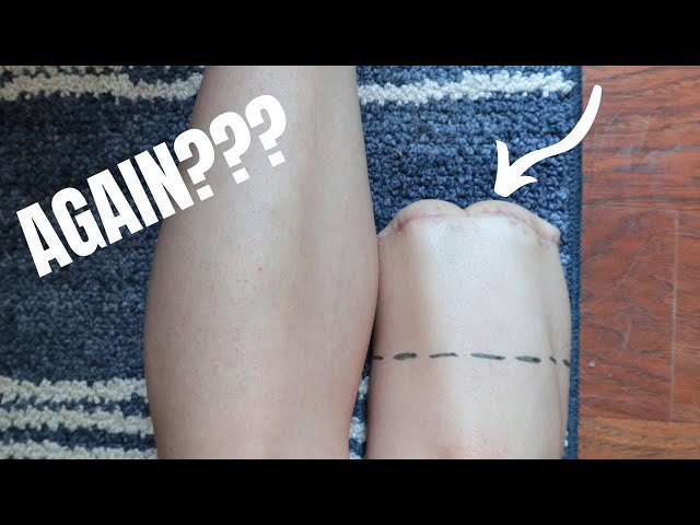 My Leg Is Getting AMPUTATED AGAIN!? 😮 Getting the same leg cut off twice....