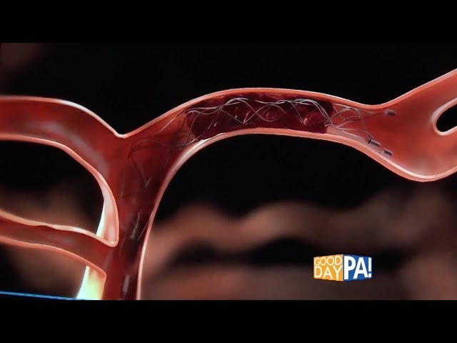 Stroke - mechanical thrombectomy procedure. Penn State Stroke Center