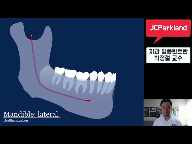 [일반인을 위한 치주강의] 6-4 치과 임플란트란- JCParkland 박정철 교수