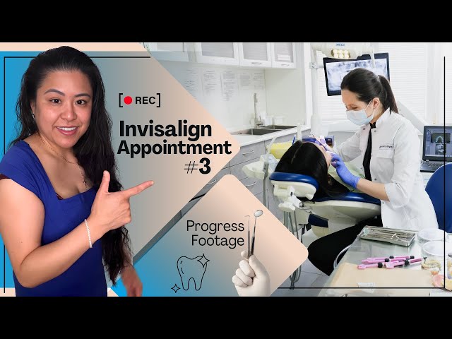 Invisalign Appointment 3: Progress Footage