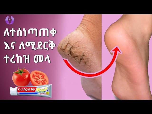 Ethiopia: ለተሰነጣጠቀ እና  ለሚደርቅ ተረከዝ ፍቱን መላ | How Remove Cracked Heels Fast Home Remedy