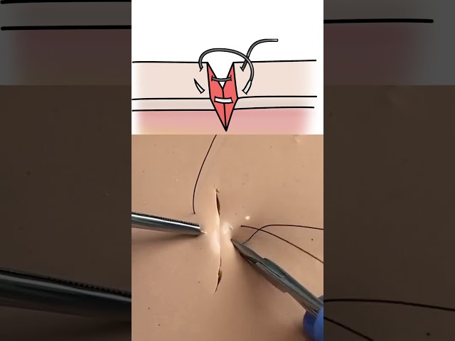 Figure of 8 Suture