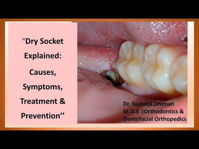 @ Complications after tooth extraction .Dry Socket: Causes, Symptoms, and treatment Explained.