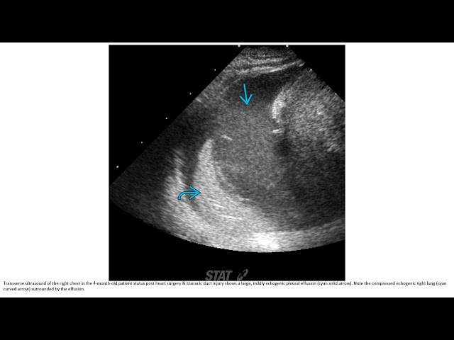 Chylothorax Imaging