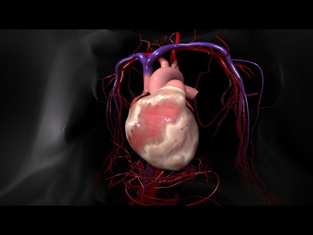 Myocardial Infarction 360