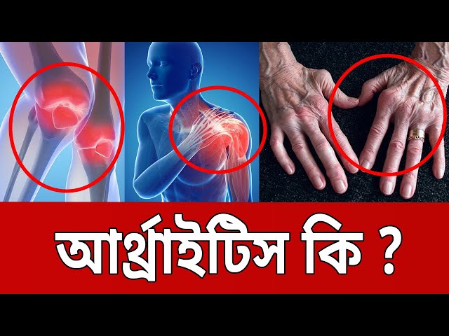 আর্থ্রাইটিস কি ? | Arthritis | Bangla News | Mytv News