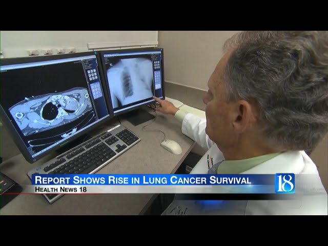 Health News 18: Report Shows Rise in Lung Cancer Survival