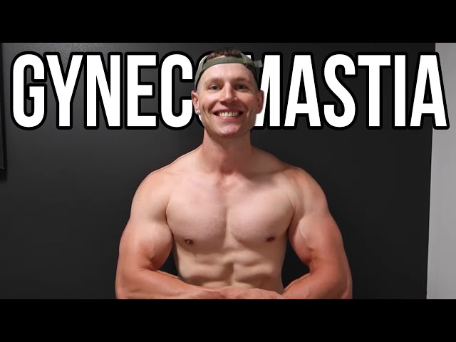 6 YEARS LATER | GYNECOMASTIA SURGERY RECOVERY UPDATE!