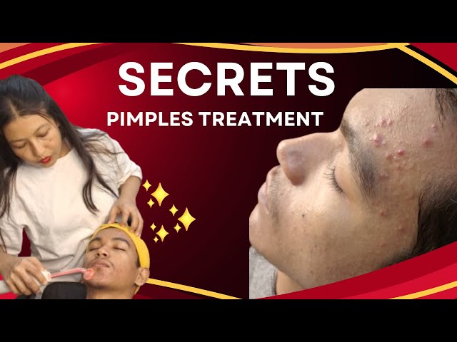 HIGH FREQUENCY SE PIMPLES KO THIK KARE | @the_adorable_look