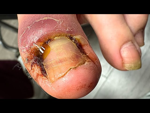 PLUGGED-UP Infected Ingrown Nail Removal!