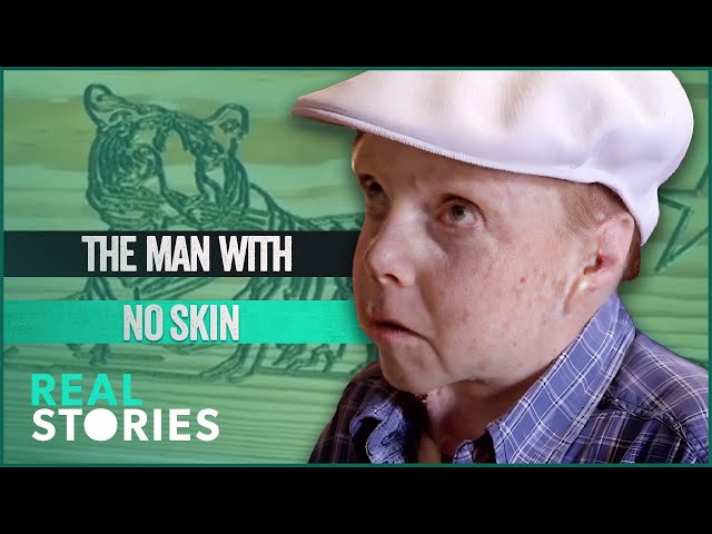 Man With Fatal Skin Condition Plans His Own Funeral | BAFTA-Winning Documentary | Real Stories