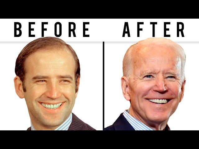 Joe Biden's NEW FACE | Plastic Surgery Analysis