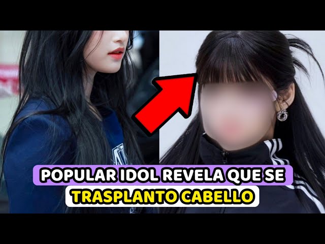 POPULAR IDOL REVELA ABIERTAMENTE QUE SE TRASPLANTO CABELLO