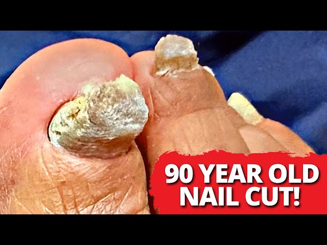 Long, Thick Nail Cutting On 90-Year-Old Patient!