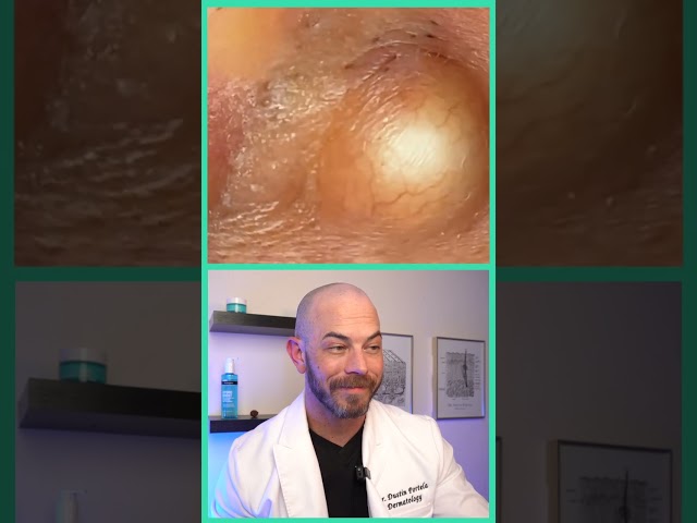 Doctor reacts to juicy cyst pop! #dermreacts #doctorreacts #pimplepop