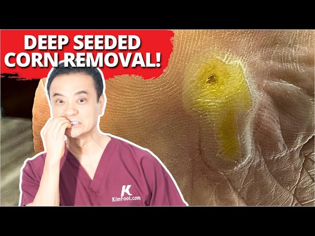 DEEP Seeded Corn Removal! (MUST WATCH)