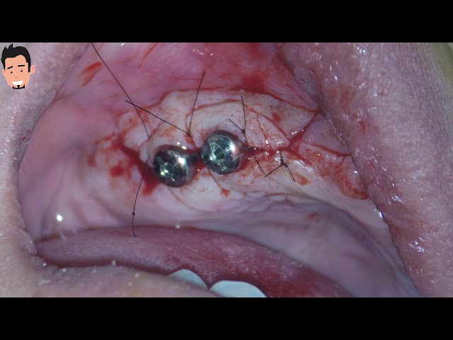 주의! 수술영상!! [Implant surgery] Dentium implant placement with SEILER microscope