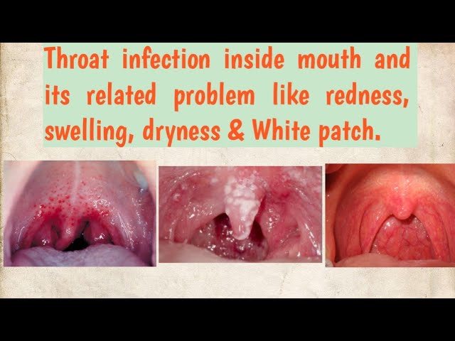 Throat irritation.Throat irritation and its causes with home remedy.