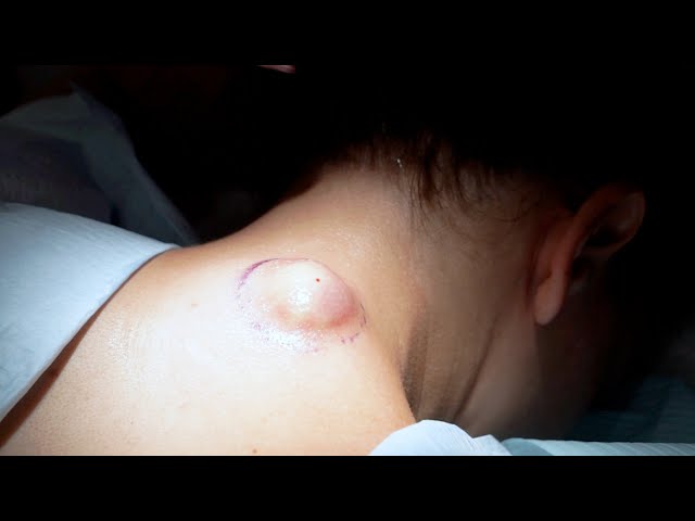 Cyst removal.