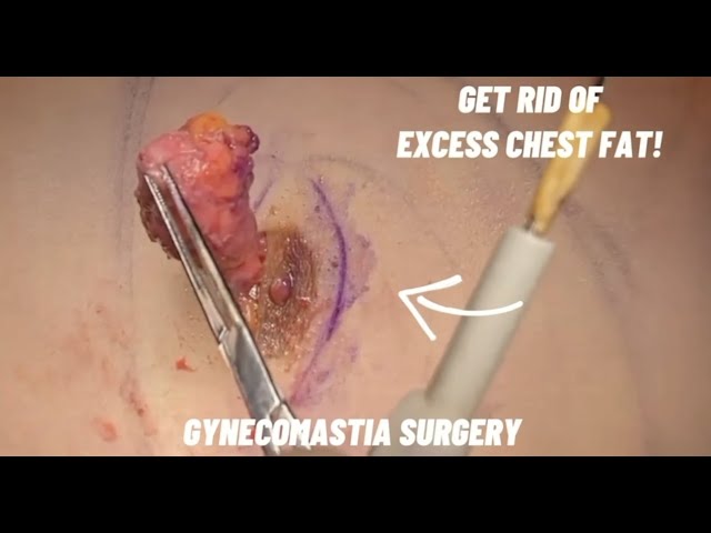 Gynecomastia Surgery Live in the Operating Room and Results Months After! | Dr. Lahijani