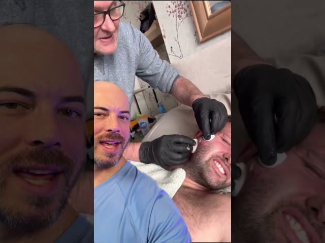 This is an EPIC cyst pop on the cheek! 😵‍💫 #trending #skincare #viralvideo