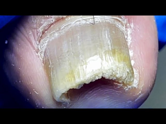 Curly Huge Ingrown Toenail, Perfectly Trimmed【Pedicure Master Lin Jun】