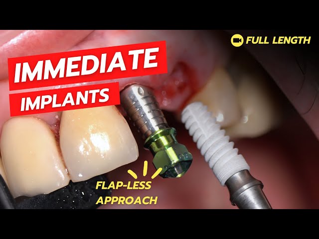 Extraction and Immediate Placement (Flapless)