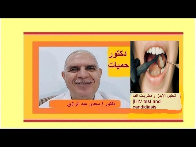 تحليل الإيدز و فطريات الفم | HIV test and candidiasis