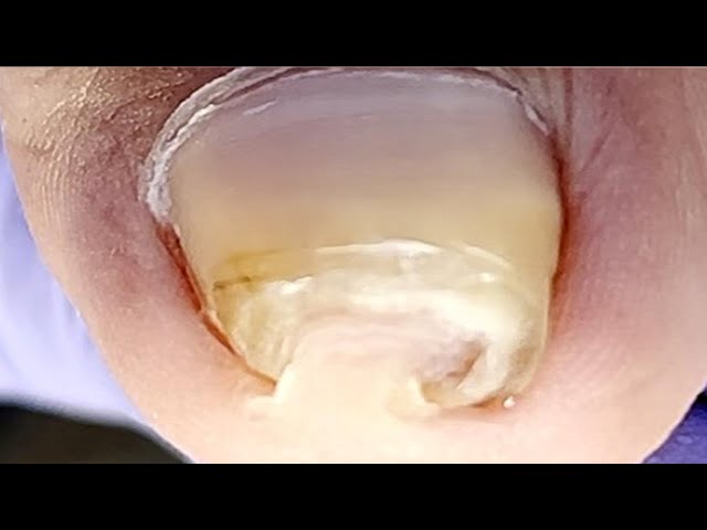 Curly Ingrown Toenails Leave Huge Damage To Toes【Xue Yidao】