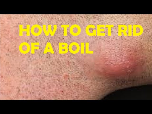 how to get rid of a boil under your armpit fast and easy