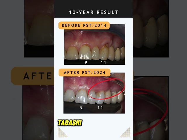 Looking for a Long-Term Solution to Gum Recession?  🦷#pinholesurgicaltechnique #gumrecession