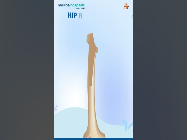 Hip Replacement | Manipal Hospital Baner