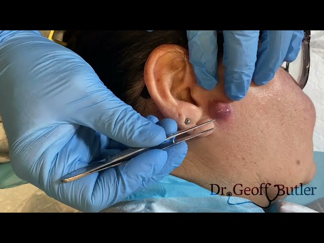 Drainage of an infected cyst in front of the ear