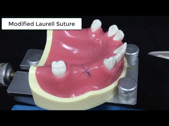 Modified Laurell suture #8 - Back to the suture