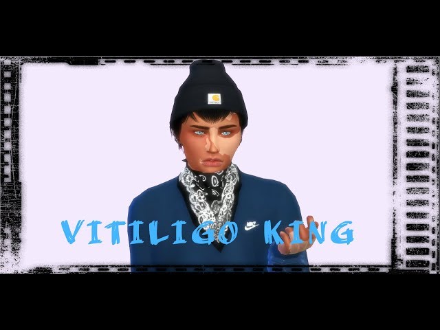 The Sims 4 Create a Sim | Vitiligo King