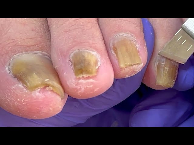 Onychomycosis infected the whole foot, trim it one by one【Doctor Liu Pedicure】