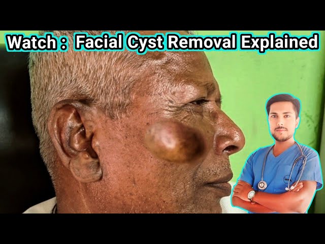 How to Remove a Sebaceous Cyst Safely: Full Procedure, Causes & Treatment Options