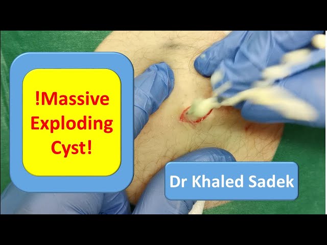 Massive 20 year Cyst Explosion. LipomaCyst.Com Dr Khaled Sadek