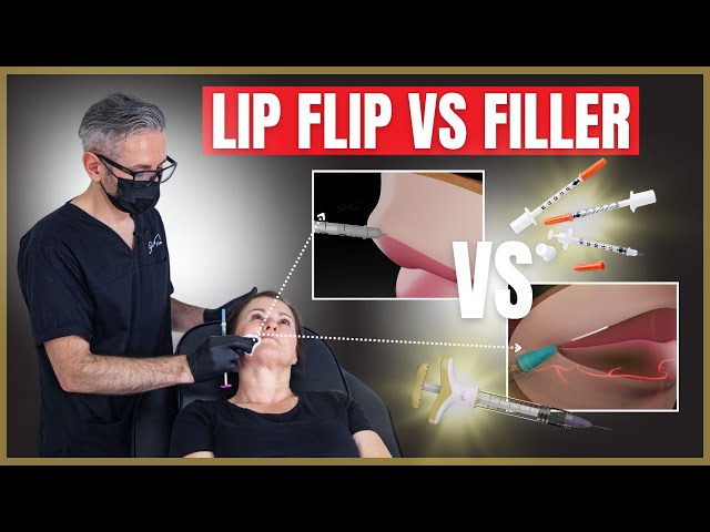 Lip Flip vs Dermal Filler | What is Lip Flip?